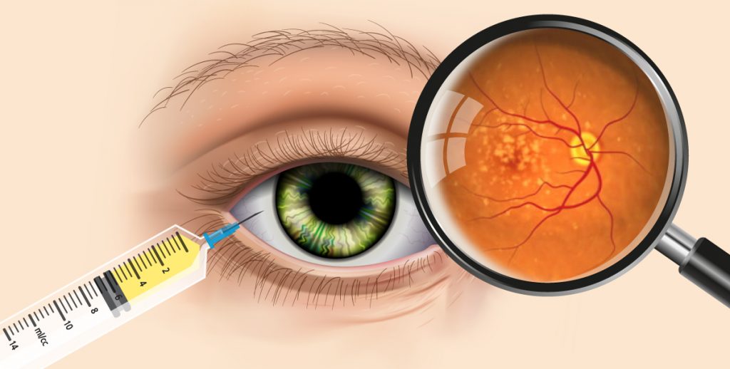 IVT는 망막질환 환자의 눈에 약물을 주사해 시력을 회복시키는 시술이다. 마취가 반드시 필요한데 시간이 긴 편이라 환자 고통과 치료 효율이 낮았다. | 그래픽: 박혜지