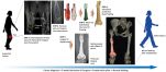 [연구그림] 3D 프린팅 Ti-6Al-4V 임플란트(인공 뼈)를 이용한 골종양 치료 진행과정