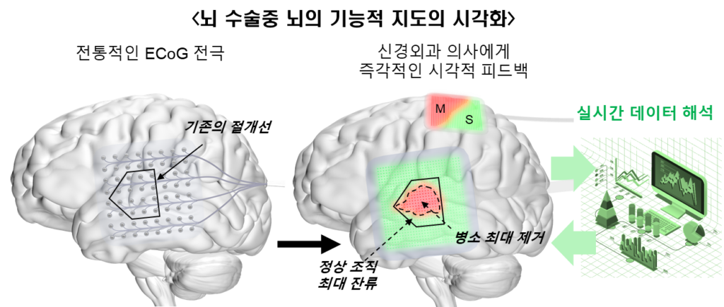 그림1. iEEG-Microdisplay를 이용한 뇌의 기능적 지도 시각화가 가능해질 경우의 기대효과