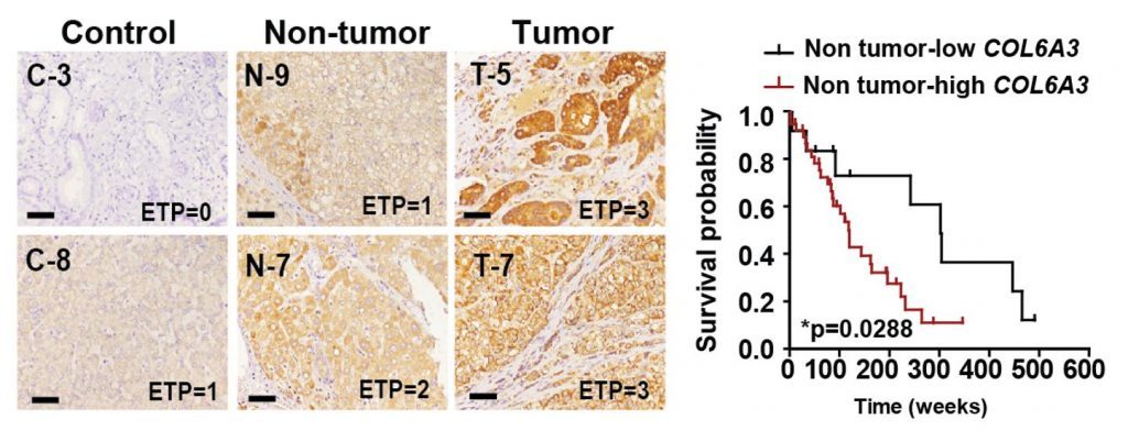 ETP expression and survival rate in liver tissue from HCC patients.