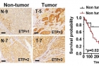ETP-expression-and-survival-rate-in-liver-tissue-from-HCC-patients.jpg
