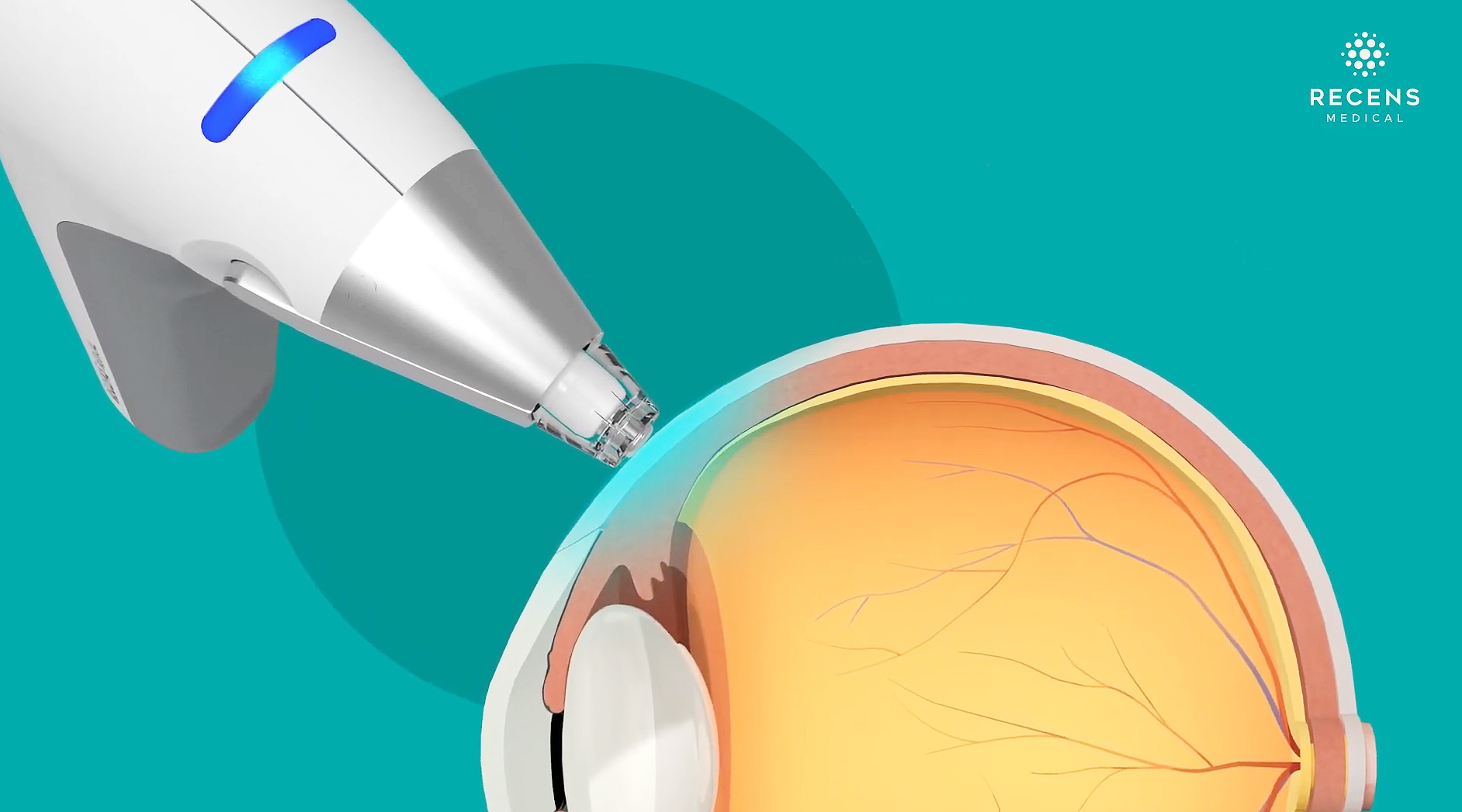 RecensMedical's OcuCool, the first Korean medical device to receive FDA De Novo approval, uses rapid precision cooling technology to provide anesthesia within 10 seconds for invasive eye treatments. Image Credit: RecensMedical Inc. 